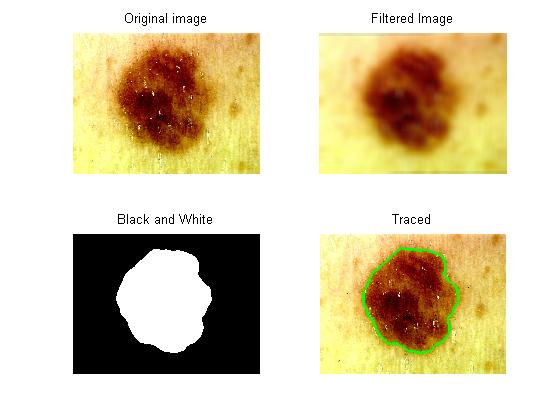 Skin Cancer causing factors - Do It Easy With ScienceProg