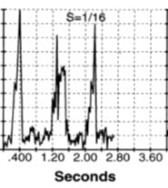 ecg_ventricular_late_potential_anomaly