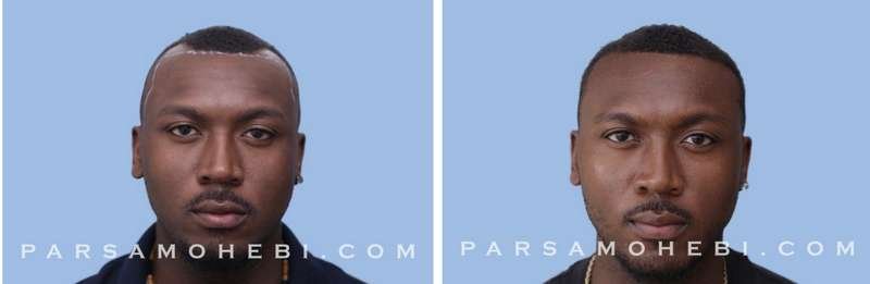 Hair Transplant Before And After