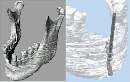 Modelling_of_an_Artificial_Jaw_based_on_the_Original_one