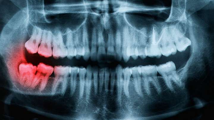Understanding the Causes of Teeth Shifting
