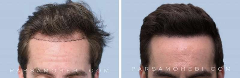 Hair Transplant Before And After