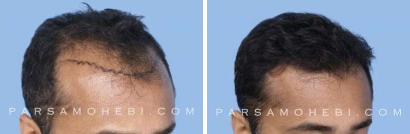 Hair Transplant Before And After